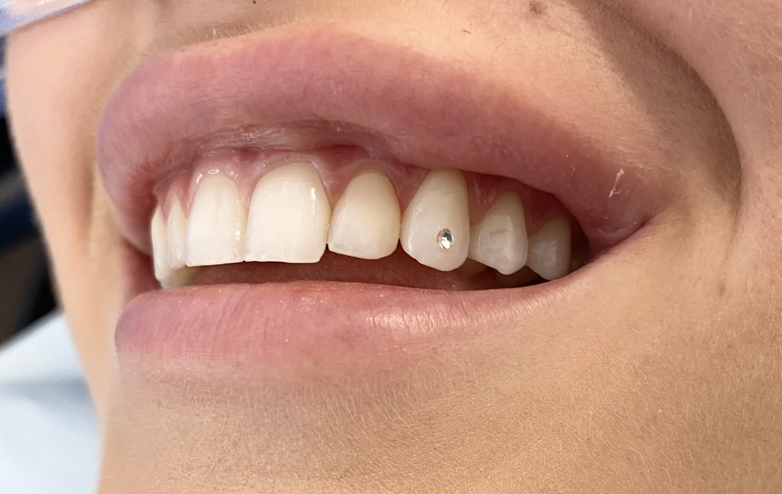 Tooth_Gem