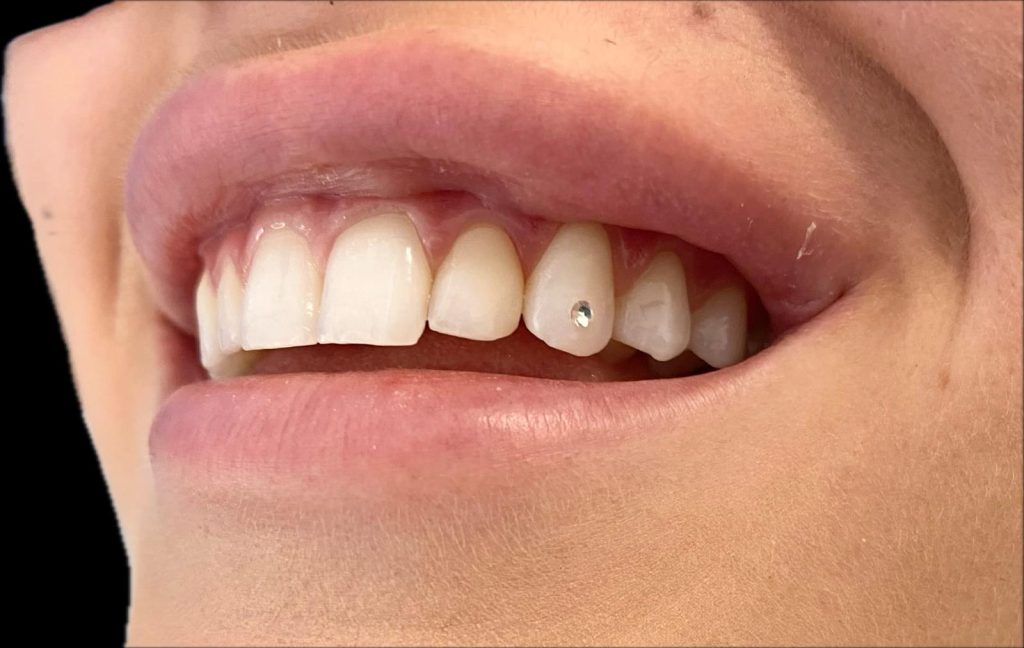 A real patient smile showcasing a sparkling tooth jewellery diamond placed safely by Dr. Fisher at Shen Dental.